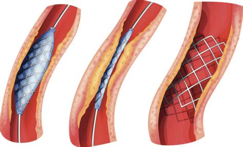 Questions Heart Patients Should Know To Ask About Stents | BlackDoctor