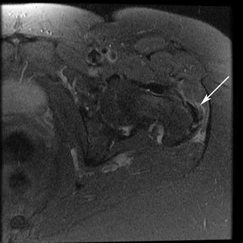 MRI of left greater trochanteric bursitis