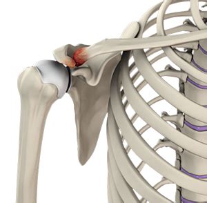 What Is Acromioclavicular Osteoarthritis