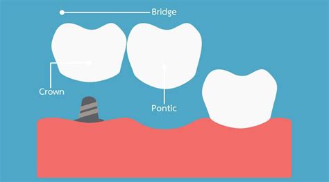 Cantilever Dental Bridge