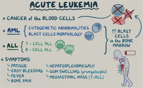 Chemotherapy for Leukemia - zeepedia.com