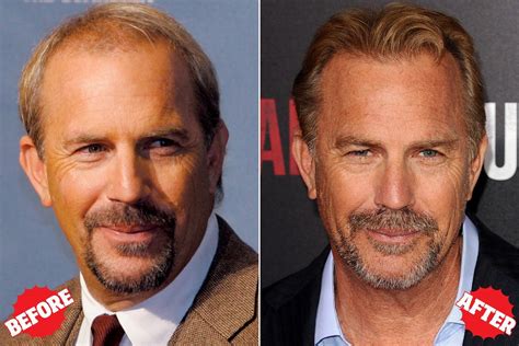 Kevin Costner Hair Transplant - Lots of Celebrities like Kevin Costner has done successful hair ...