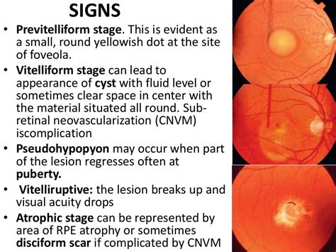 MACULAR DYSTROPHIES