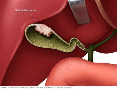 Gallbladder cancer - Symptoms and causes - Mayo Clinic