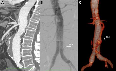 Laparoscopic Transarterial Embolization of Type II Endoleak after ...