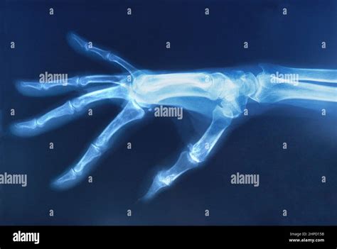 Hand bones hi-res stock photography and images - Alamy