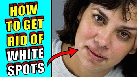 How To Get Rid of White Spots Skin & Face Naturally - YouTube