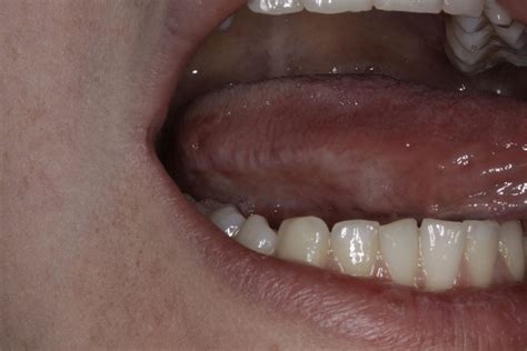 Oral Lichen Planus Cancer