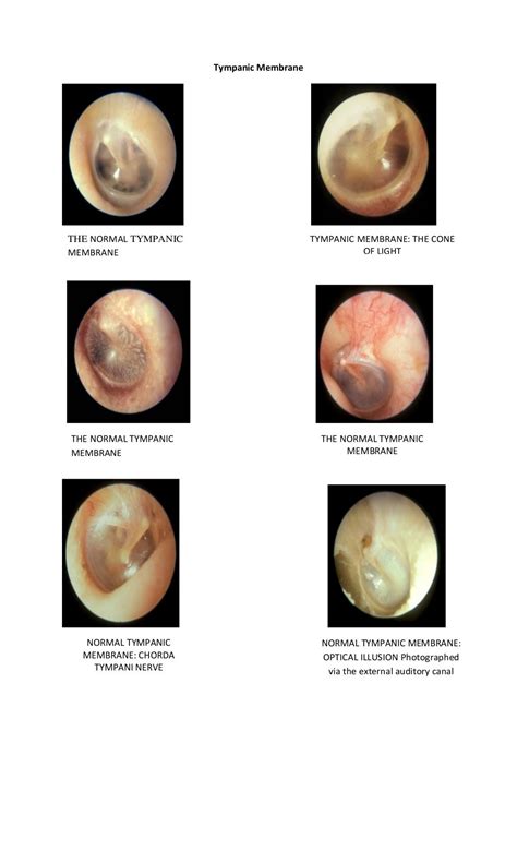 Tympanic membrane dr. fadil