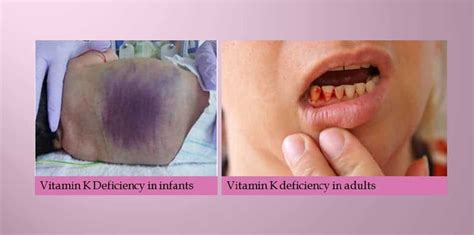 Vitamin K & Deficiency - New