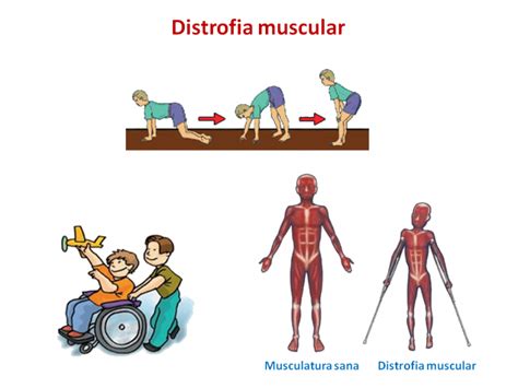 ¿Qué son las distroglicanopatías? | Guía metabólica