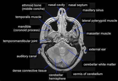 Paranasal sinus cancer