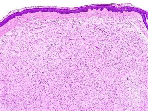 neurofibroma pictures - pictures, photos