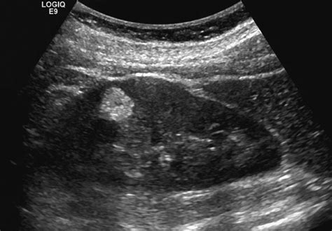 Renal Ultrasound Made Easy: Step-By-Step Guide - POCUS 101