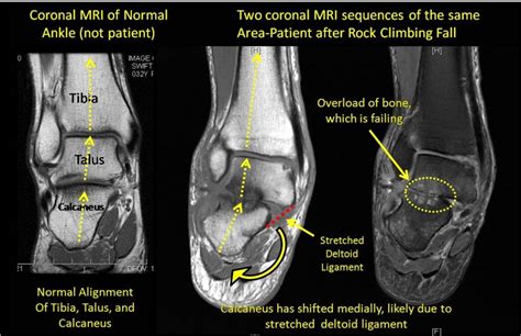 Ankle Ligament Injuries can Lead to Severe Arthritis in the Ankle