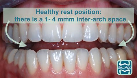 Should Your Teeth Touch When Resting & Mewing?