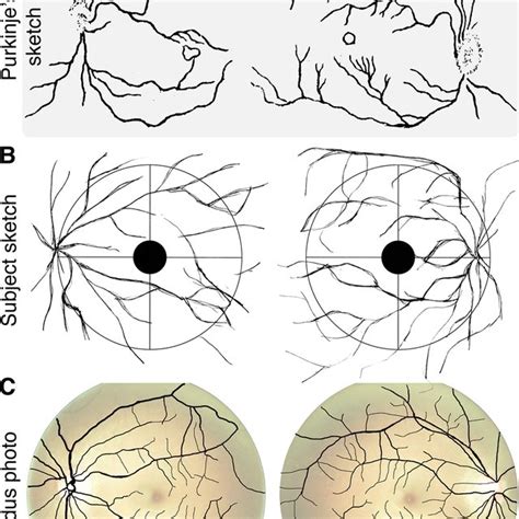 Raw fundus photographs. Unedited fundus photographs (OS = left eye, OD ...