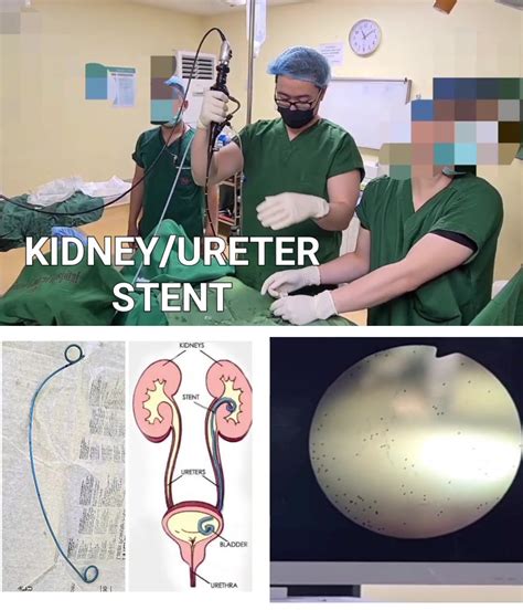 Kidney and Ureter Stent Removal - A ureteral stent is a thin tube that’s placed in your ureter ...