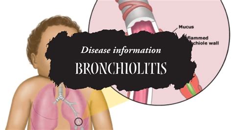 #bronchiolitis: What it is, symptoms, causes and treatment - YouTube