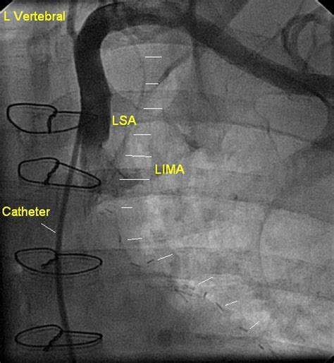 Occluded left internal mammary artery (LIMA) graft – All About Cardiovascular System and Disorders