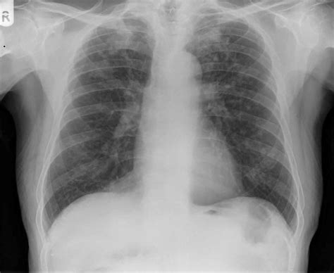 Silicosis causes, symptoms, diagnosis, treatment & silicosis prognosis