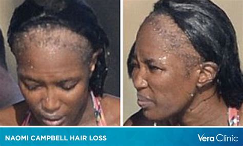 Naomi Campbell Hair Loss: From Bald Spots to Natural Hair