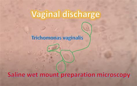 Trichomoniasis: Introduction, Symptoms, risk factors, lab diagnosis