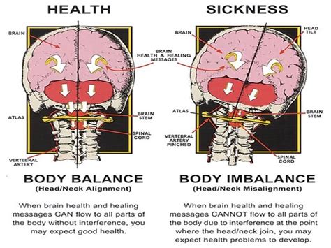 atlas vertebrae misalignment - Google Search | Subluxation, Upper cervical chiropractic ...