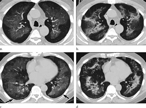 Lung injuries from vaping have characteristic | EurekAlert!