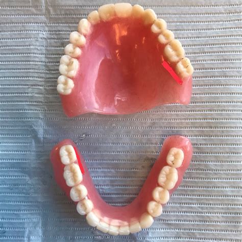 Upper Complete Denture and Lower Implant Overdenture - THE TRUE LIFE OF A DENTAL STUDENT & AEGD ...