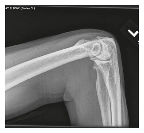 X-ray of the left elbow joint and bilateral knee joints. (a) Moderate... | Download Scientific ...