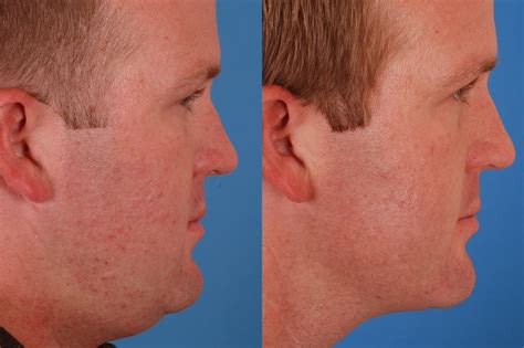 Neck Liposuction Before & After Photos | Dr. Bassichis