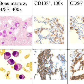 The bone marrow (BM) trephine biopsy sample histopathological ...