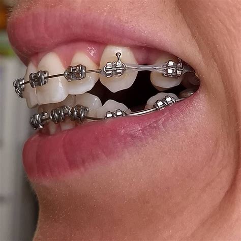 #braces #girlswithbraces #metalbraces #powerchain | Braces colors, Braces tips, Metal braces