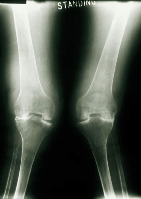 X-ray Of Knee Joints With Rheumatoid Arthritis by Medical Photo Nhs Lothian/science Photo Library