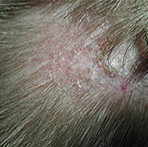 itchy rash on scalp - pictures, photos