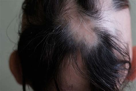 3 signs of regrowth in alopecia areata | Lady Alopecia