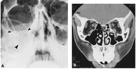 Facial Trauma | Radiology Key