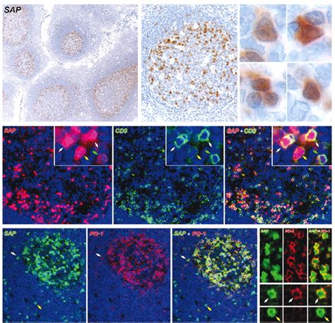 Expression of two markers of germinal center T cells (SAP and PD-1) in ...