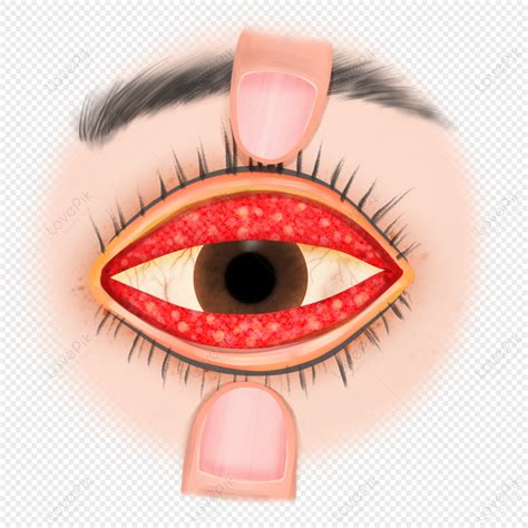 Hand Drawn Science Trachoma Symptoms, Eye Cataract, Medicine, Sick PNG ...