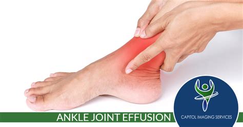 Ankle joint effusion - Capitol Imaging Services