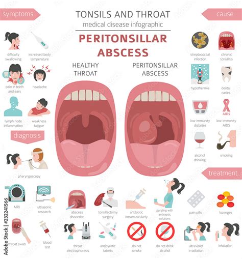 Tonsils and throat diseases. Peritonsillar abscess symptoms, treatment icon set. Medical ...