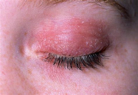 Eczema on eyelid – Bild kaufen – 11838753 Science Photo Library