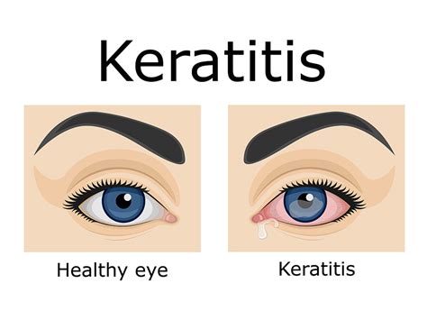 Bacterial Keratitis: Causes, Symptoms, And Treatment - Anaheim Eye Institute