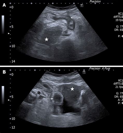 Acute Appendicitis On Ultrasound