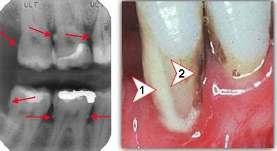 Dentistry lectures for MFDS/MJDF/NBDE/ORE: A NOTE ON DENTAL CALCULUS