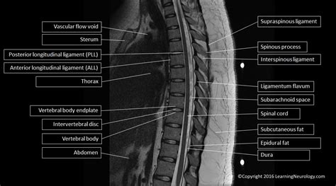 Approach to MRI Spine | LearningNeurology.com