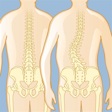 Scoliosis Symptoms