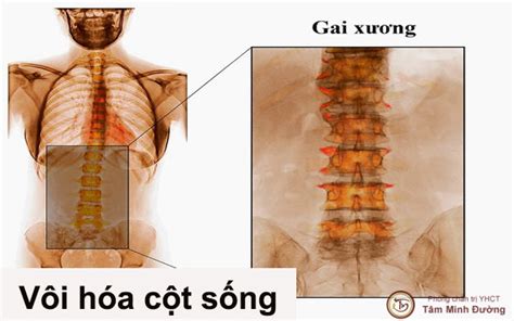 Vôi hóa cột sống lưng, đốt sống cổ là gì? Dấu hiệu và cách chữa - Tâm ...