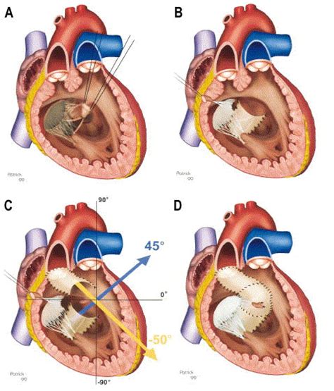 Intraventricular repair of double-outlet right ventricle with ...